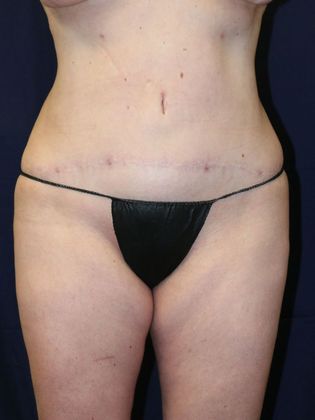 Liposuction & Safe Lipo: Case 24 - After