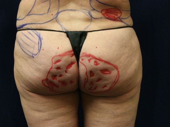 Liposuction & Safe Lipo: Case 27 - Before