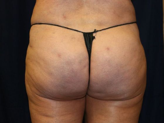 Liposuction & Safe Lipo: Case 27 - After