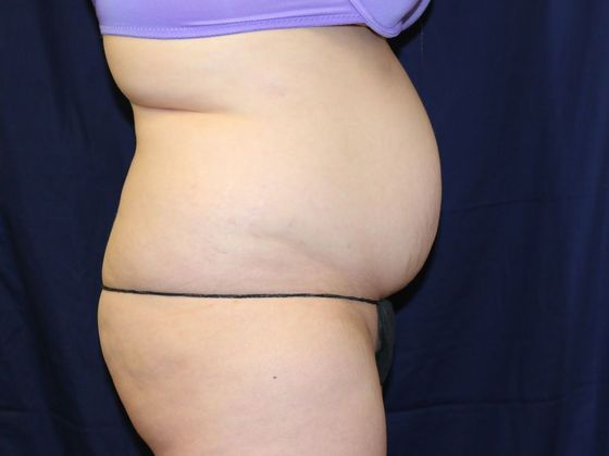 Liposuction & Safe Lipo: Case 28 - Before