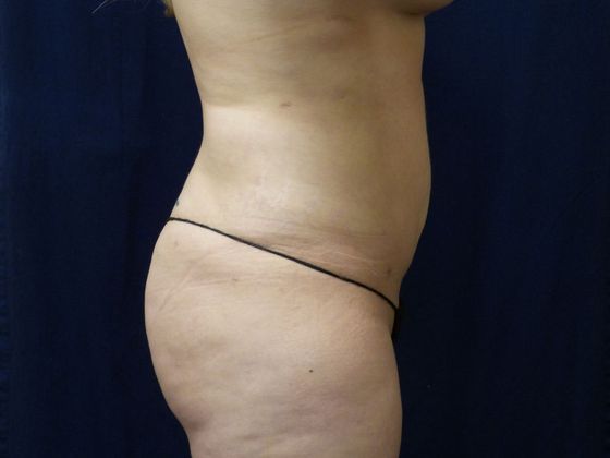 Liposuction & Safe Lipo: Case 28 - After