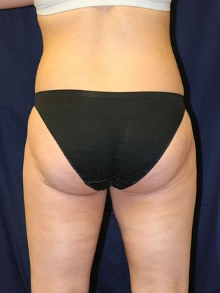 Liposuction & Safe Lipo: Case 26 - After