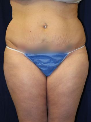 Liposuction & Safe Lipo: Case 29 - Before