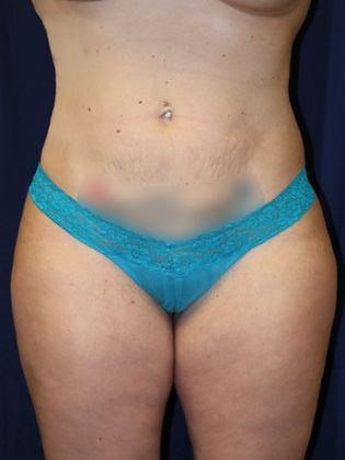 Liposuction & Safe Lipo: Case 29 - After