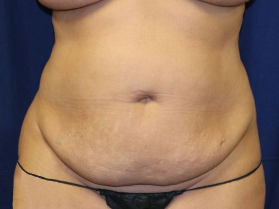 Liposuction & Safe Lipo: Case 20 - Before