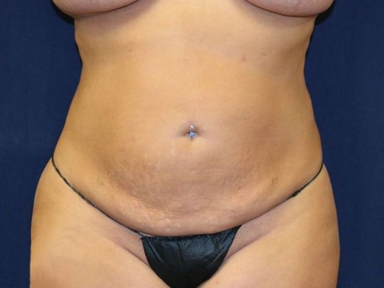Liposuction & Safe Lipo: Case 20 - After