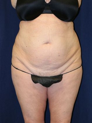 Liposuction & Safe Lipo: Case 32 - Before