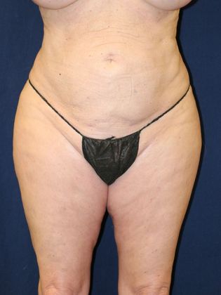 Liposuction & Safe Lipo: Case 32 - After