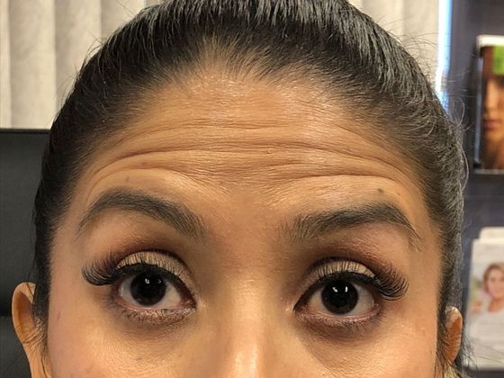 BOTOX® Cosmetic*: Case 5 - Before