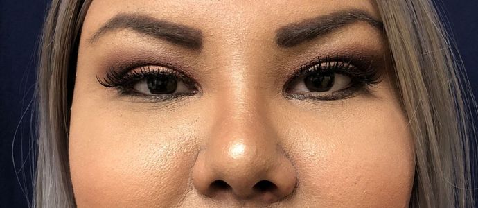 Cosmetic Injectables & Fillers*: Case 30 Non-Surgical Rhinoplasty - After