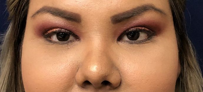 Cosmetic Injectables & Fillers*: Case 30 Non-Surgical Rhinoplasty - Before