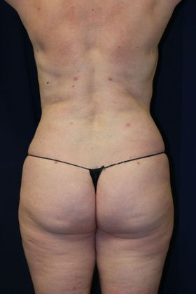 Liposuction & Safe Lipo: Case 34 - After
