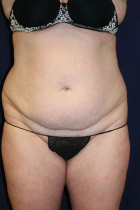 Liposuction & Safe Lipo: Case 34 - Before
