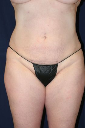 Liposuction & Safe Lipo: Case 34 - After