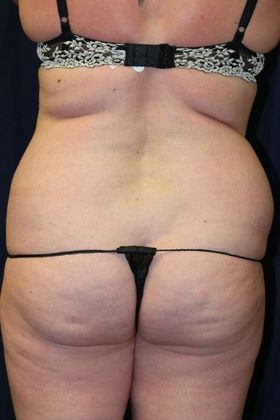 Liposuction & Safe Lipo: Case 34 - Before