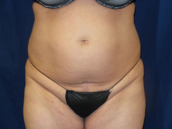 Liposuction & Safe Lipo: Case 36 - Before