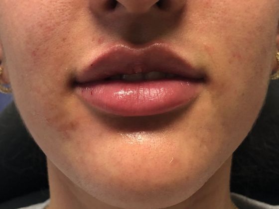Cosmetic Injectables & Fillers*: Case 36 Lip Filler - After
