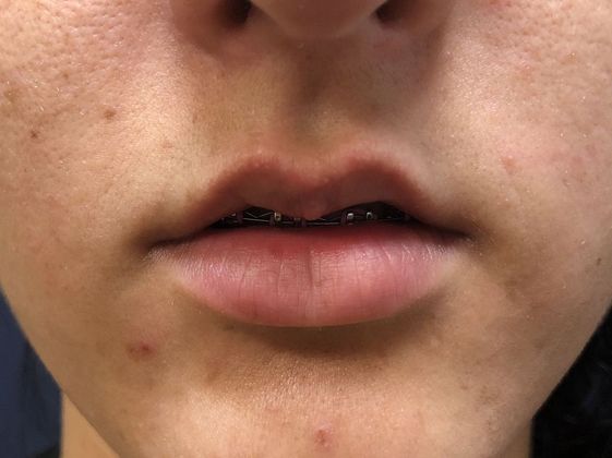 Cosmetic Injectables & Fillers*: Case 36 Lip Filler - Before