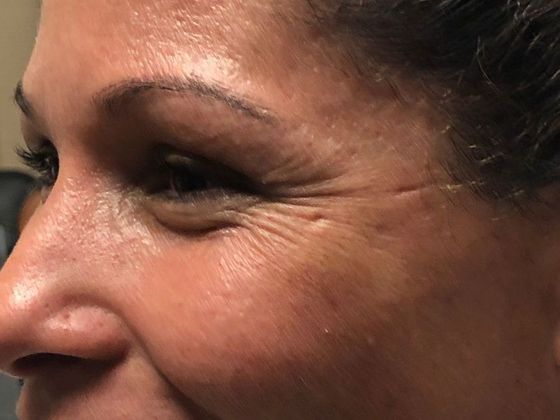 BOTOX® Cosmetic*: Case 3 - Before