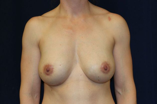 Breast Implant Removal and Exchange: Case 8 - After