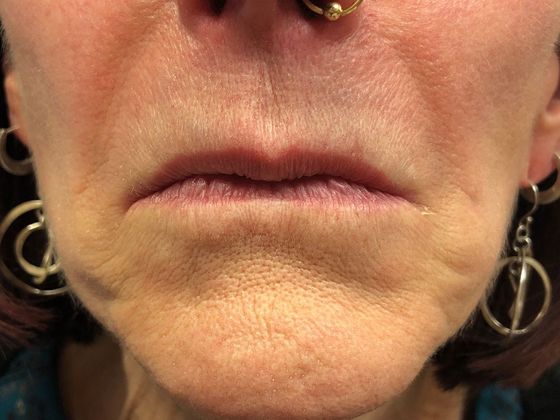Cosmetic Injectables & Fillers*: Case 14 Lip Filler - Before