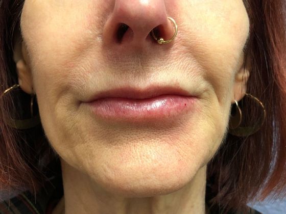 Cosmetic Injectables & Fillers*: Case 14 Lip Filler - After