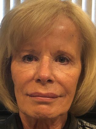 Cosmetic Injectables & Fillers*: Case 19 Lower Face Filler - After