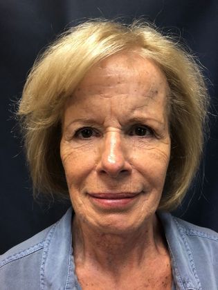 Cosmetic Injectables & Fillers*: Case 19 Lower Face Filler - Before