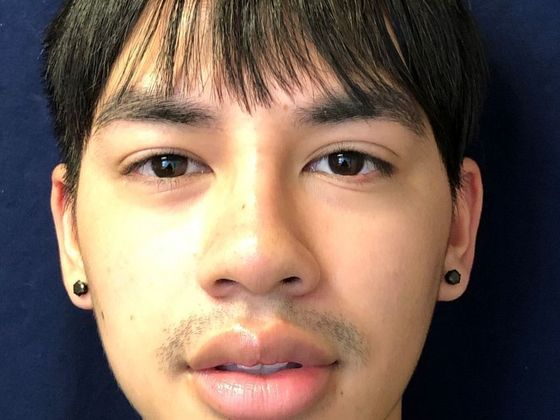 Cosmetic Injectables & Fillers*: Case 29 Non-Surgical Rhinoplasty - After