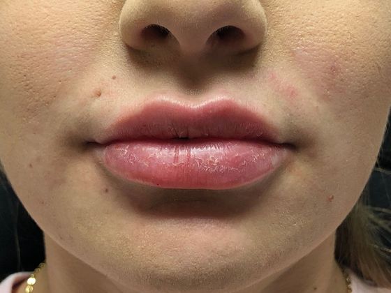 Cosmetic Injectables & Fillers*: Case 13 Lip Filler - After