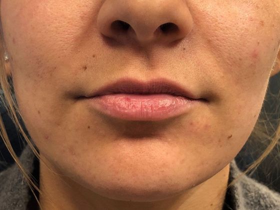 Cosmetic Injectables & Fillers*: Case 13 Lip Filler - Before