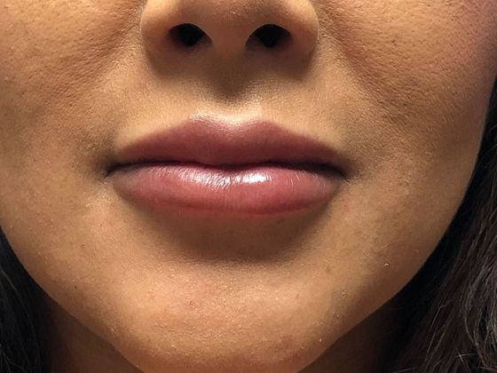 Cosmetic Injectables & Fillers*: Case 12 Lip Filler - After
