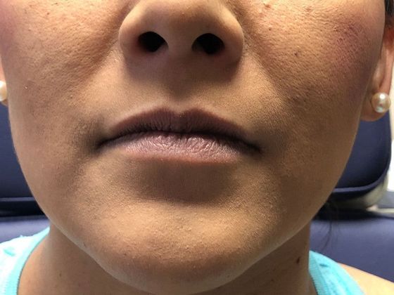 Cosmetic Injectables & Fillers*: Case 12 Lip Filler - Before
