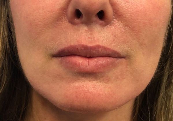 Cosmetic Injectables & Fillers*: Case 11 Lip Filler - Before