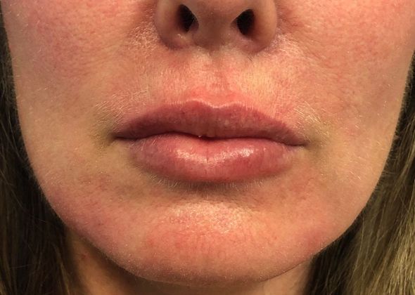 Cosmetic Injectables & Fillers*: Case 11 Lip Filler - After