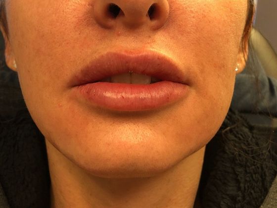 Cosmetic Injectables & Fillers*: Case 10 Lip Filler - After