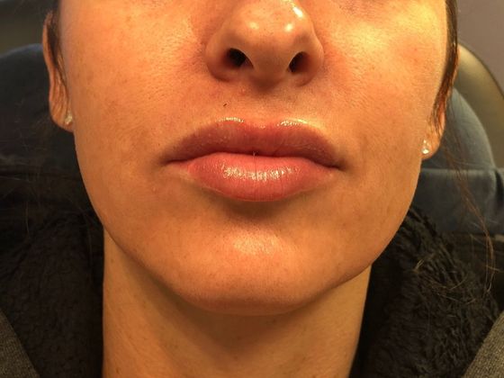 Cosmetic Injectables & Fillers*: Case 10 Lip Filler - Before