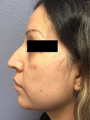 Cosmetic Injectables & Fillers*: Case 27 Non-Surgical Rhinoplasty - Before