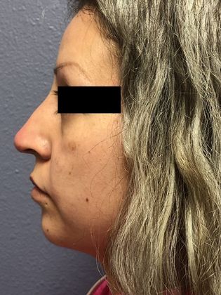 Cosmetic Injectables & Fillers*: Case 27 Non-Surgical Rhinoplasty - After