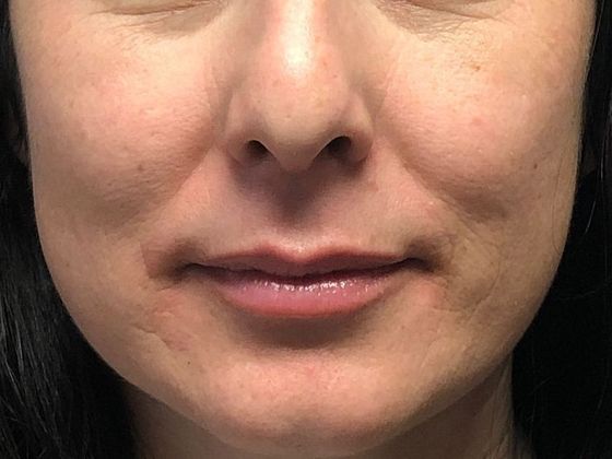 Cosmetic Injectables & Fillers*: Case 9 Lip Filler - Before