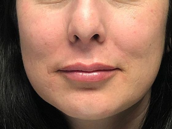 Cosmetic Injectables & Fillers*: Case 9 Lip Filler - After