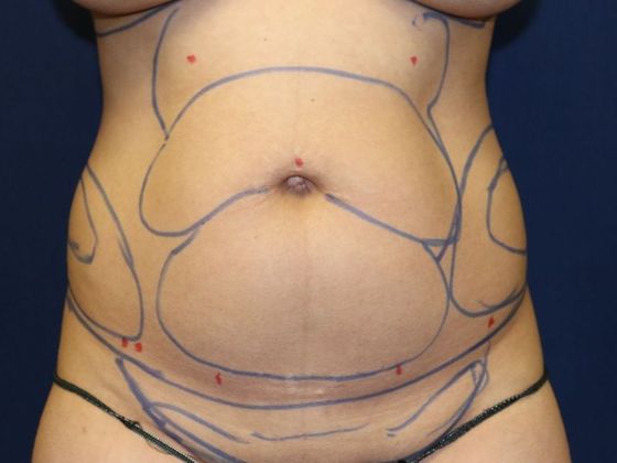 Liposuction & Safe Lipo: Case 38 - Before