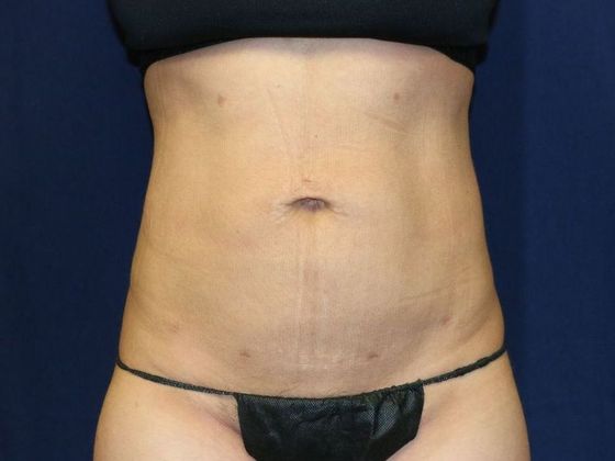Liposuction & Safe Lipo: Case 38 - After