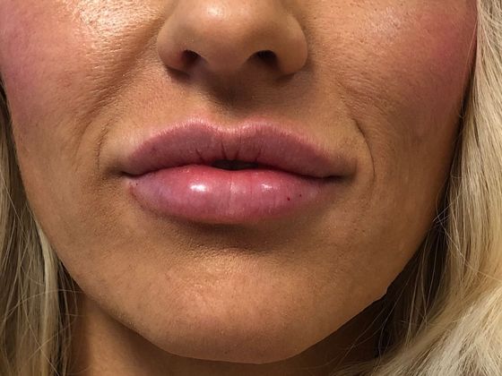 Cosmetic Injectables & Fillers*: Case 38 Lip Filler - After