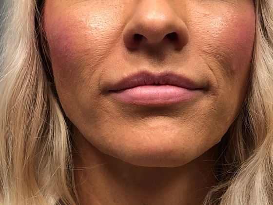 Cosmetic Injectables & Fillers*: Case 38 Lip Filler - Before