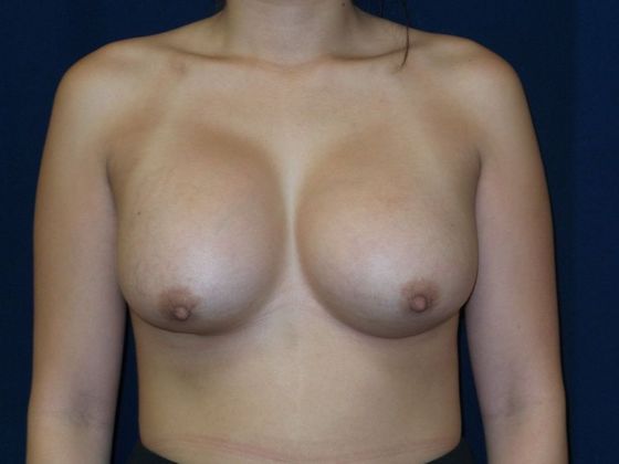 Breast Implant Removal and Exchange: Case 10 - Before