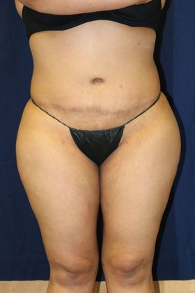 Brazilian Butt Lift : Case 4 - After