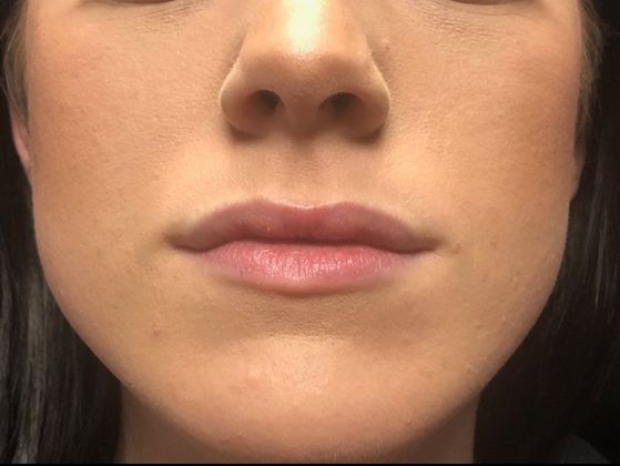 Cosmetic Injectables & Fillers*: Case 8 Lip Filler - Before