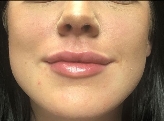 Cosmetic Injectables & Fillers*: Case 8 Lip Filler - After