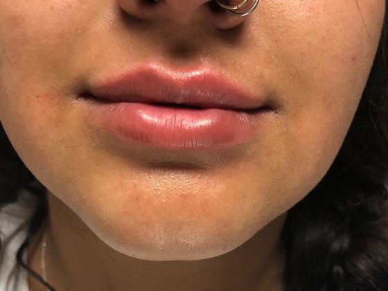 Cosmetic Injectables & Fillers*: Case 7 Lip Filler - After